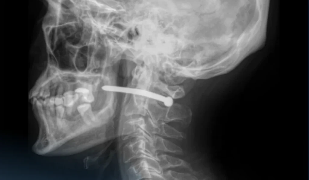 Петропавлда жөндеу жұмыстары кезінде ер адамның мойнына шеге қадалып қалды