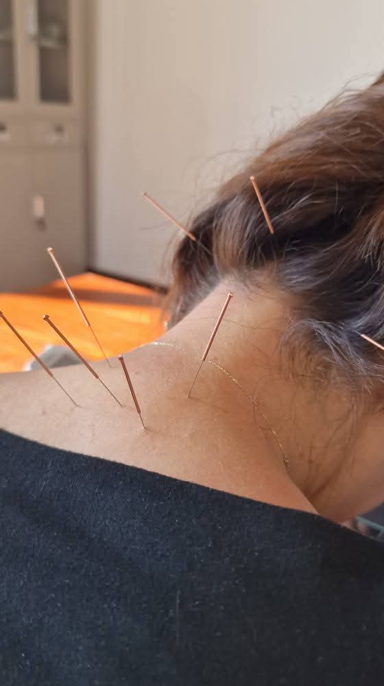 Иглоукалывание в Хоргосе