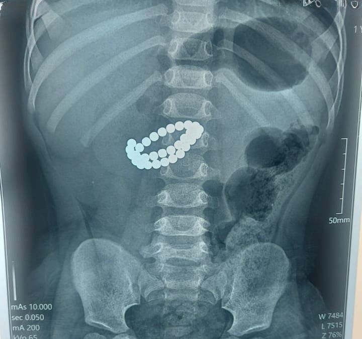 Алматыда хирургтер 31 магнит жұтқан баланың өмірін сақтап қалды